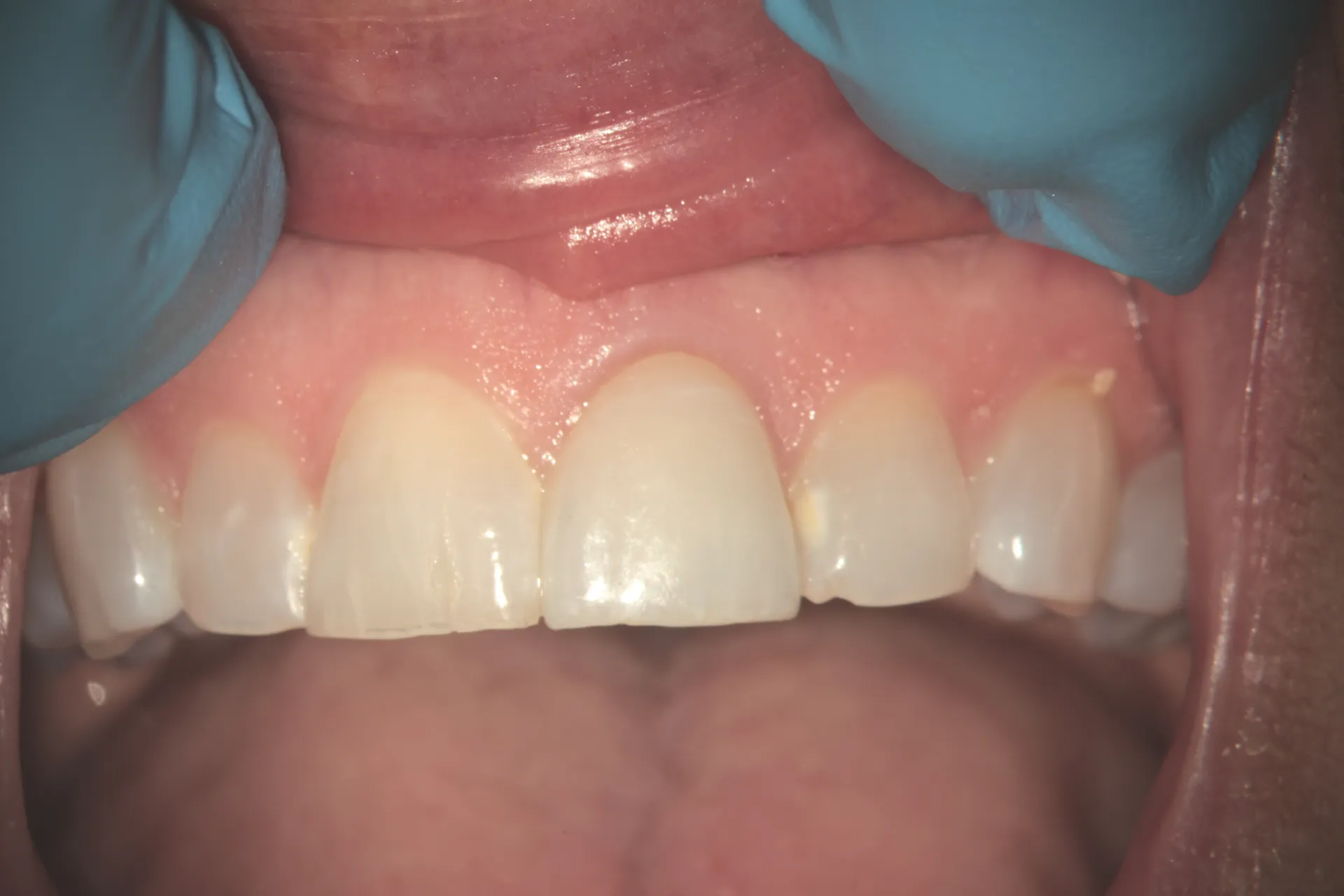 One-year recall showing stable tooth with definitive crown restoration